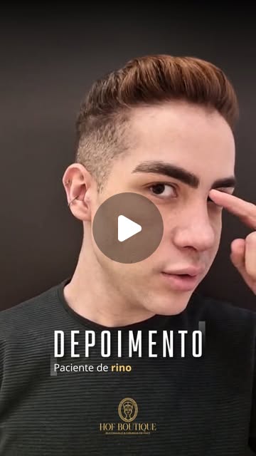 Neste caso, a rino corrigiu uma ponta nasal baixa e uma assimetria que comprometiam a harmonia facial do nosso paciente.